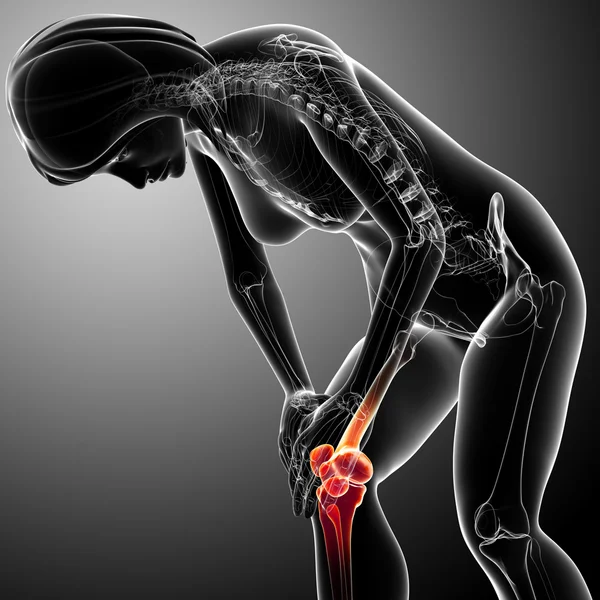 여성 무릎 통증 — 스톡 사진