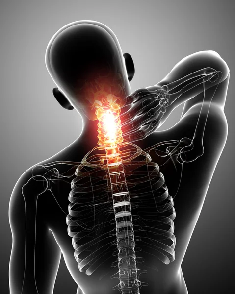 X-ray of neck pain — Stock Photo, Image