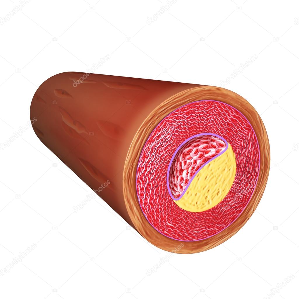 Artery atherosclerotic plaque