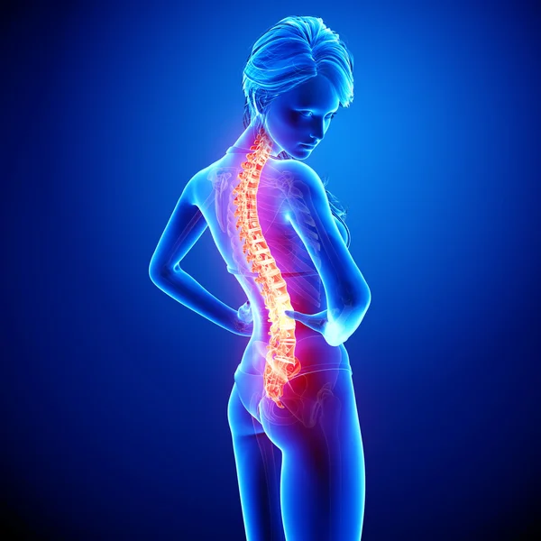 Εικονογράφηση του πόνου ανθρώπινη σπονδυλική στήλη με επισημασμένης σπονδυλική σε μπλε Φωτογραφία Αρχείου