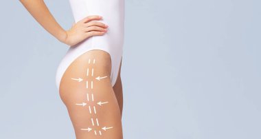 kadın bedeninin üzerine çizim oklar. yağ kaybetmek, liposuction ve selülit Temizleme kavramı.