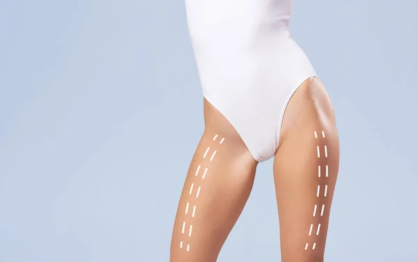 Cuerpo femenino con las flechas de dibujo. Perder grasa, liposucción y eliminación de celulitis. —  Fotos de Stock