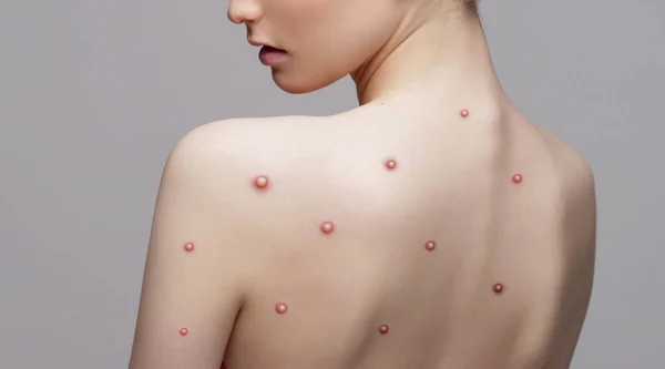 年轻女人感染了猴痘 皮肤皮疹 痤疮和背上的灼伤 大流行病 病毒感染 疫苗接种和保健概念 — 图库照片