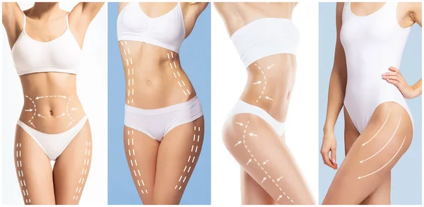 Female body with the drawing arrows on it. The concept of fat lose, liposuction and cellulite removal.