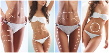 Female body with the drawing arrows on it. The concept of fat lose, liposuction and cellulite removal.