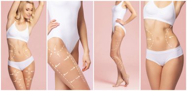 Female body with the drawing arrows on it. The concept of fat lose, liposuction and cellulite removal.