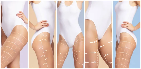 Female Body Drawing Arrows Concept Fat Lose Liposuction Cellulite Removal — Photo
