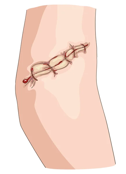 dirsek üzerinde iz.