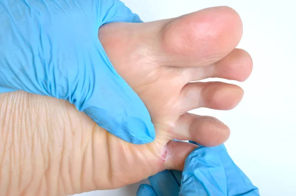 足の皮膚の真菌性病変 皮が割れて — ストック写真