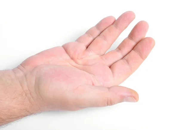 Dupuytren Contracture Also Called Dupuytren Disease Morbus Dupuytren Viking Disease — Stock Photo, Image