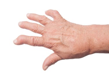 Hand With Rheumatoid Arthritis clipart