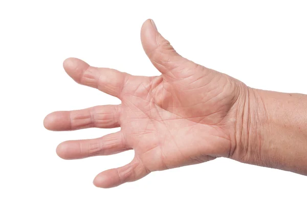 Hand med reumatoid artrit — Stockfoto