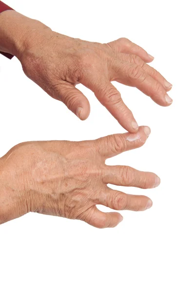 Artrite reumatoide dos dedos. Usando creme médico — Fotografia de Stock