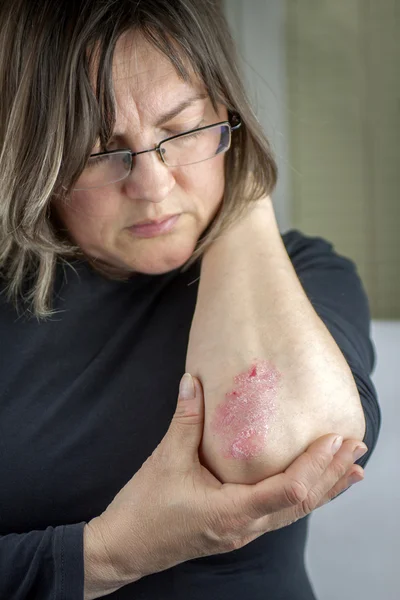 Psoriasis on elbow — Stock Photo, Image