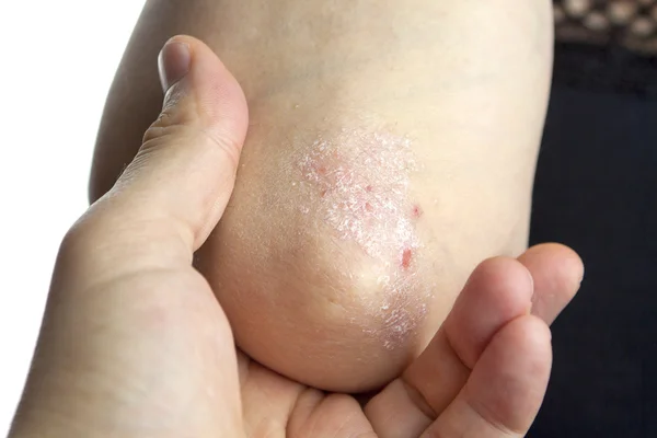 Psoriasis — Photo