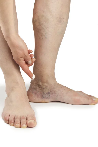 Varicose veins — Stock Photo, Image