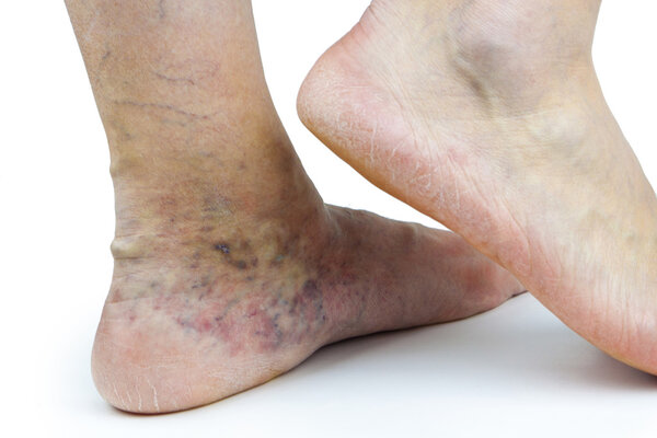 Varicose veins