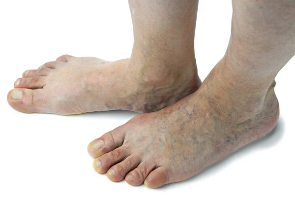 Varicose veins — Stock Photo, Image