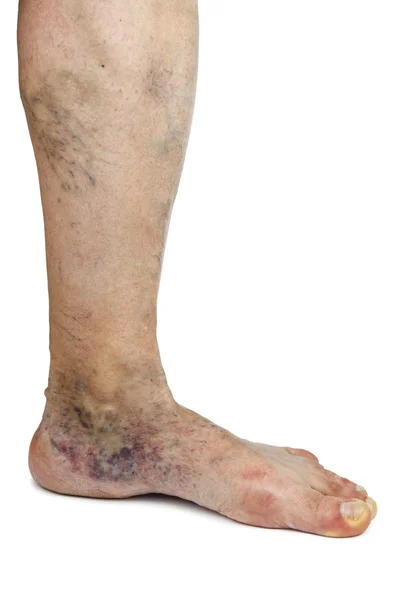 Varicose vein — Stock Photo, Image