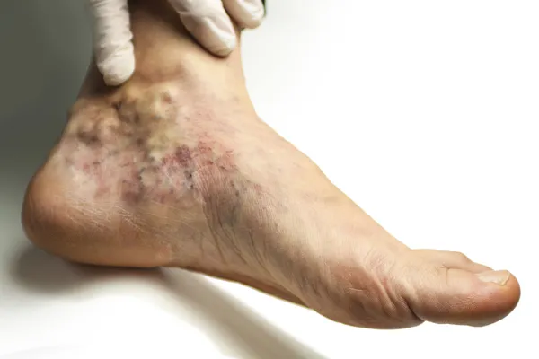 Varicose vein — Stock Photo, Image