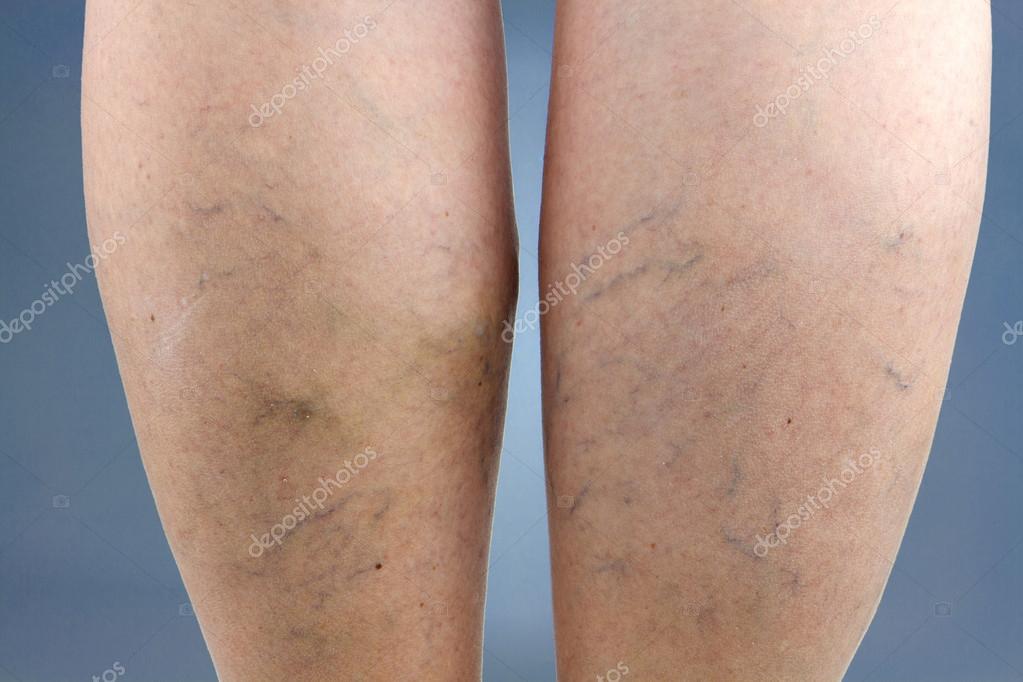 colani de pre în varicose vector photo varicose tratamentul poporului genunchi