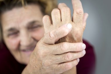 Hands Of Woman Deformed From Rheumatoid Arthritis clipart