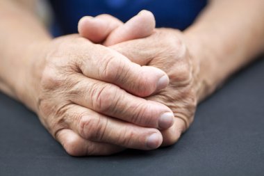 Romatoid artrit deforme kadının elleri