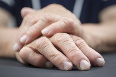 Hands Of Woman Deformed From Rheumatoid Arthritis clipart