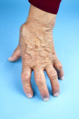 Romatoid artrit deforme kadının elleri