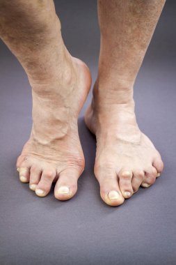 Romatoid artrit deforme kadın ayakları