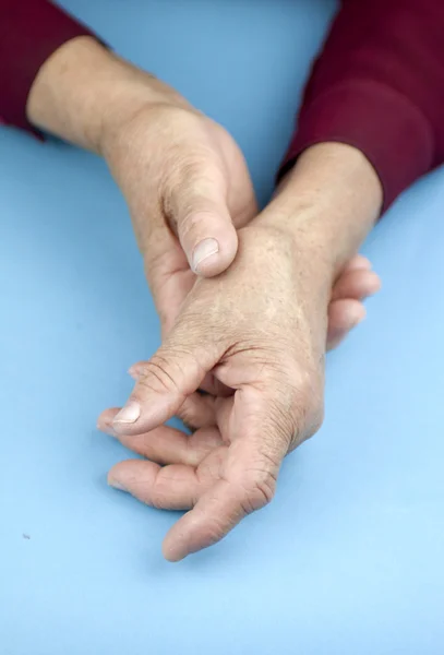 Hand einer an rheumatoider Arthritis deformierten Frau — Stockfoto