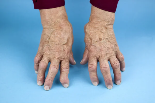 Hands Of Woman Deformed From Rheumatoid Arthritis — Stock Photo, Image