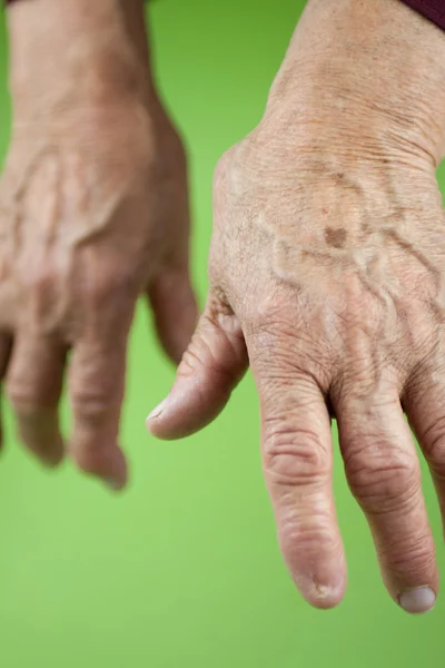 Handen van vrouw vervormd van reumatoïde artritis — Stockfoto