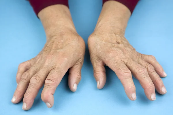 류 마티스 관절염에서 변형 하는 여자의 손 — 스톡 사진