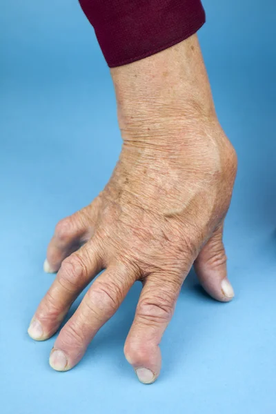 Mão da mulher deformada da artrite reumatoide — Fotografia de Stock