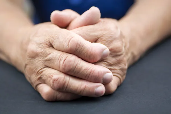 Руки женщины изуродованы ревматоидным артритом Лицензионные Стоковые Изображения
