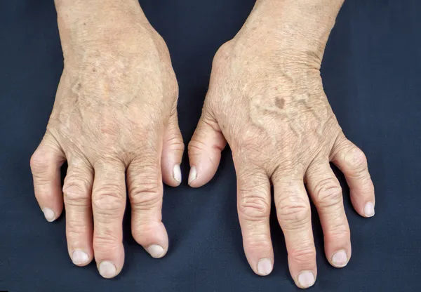 Руки женщины изуродованы ревматоидным артритом Лицензионные Стоковые Фото