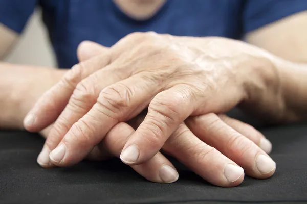 Рука женщины деформирована от ревматоидного артрита Стоковая Картинка