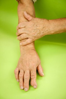 Romatoid artrit deforme kadının elleri