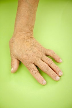 Hand Of Woman Deformed From Rheumatoid Arthritis clipart