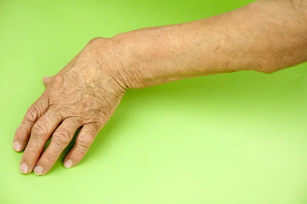 Hand einer an rheumatoider Arthritis deformierten Frau — Stockfoto