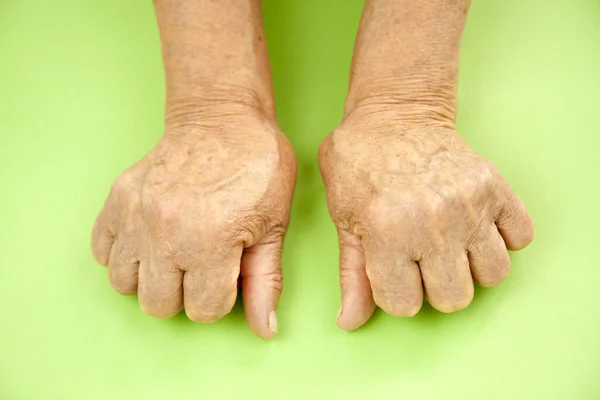 Hand van vrouw vervormd van reumatoïde artritis — Stockfoto