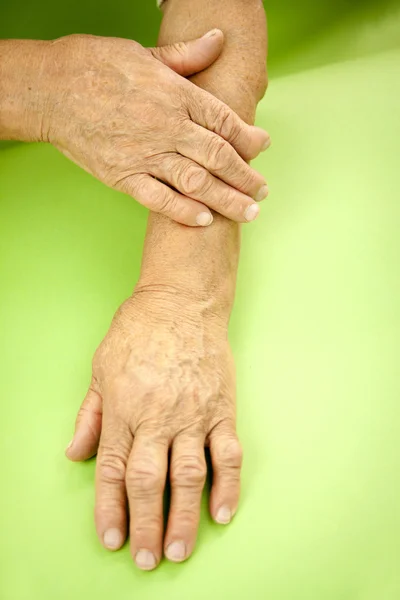 Handen van vrouw vervormd van reumatoïde artritis — Stockfoto