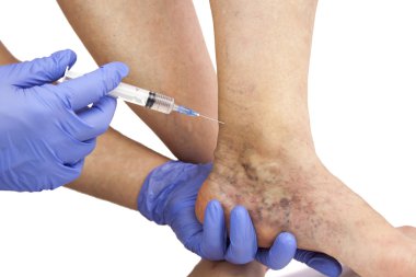 Varicose veins treatment clipart
