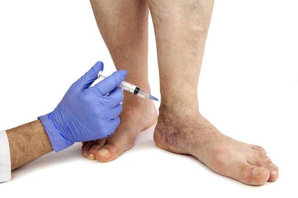 Varicose veins treatment — Stock Photo, Image