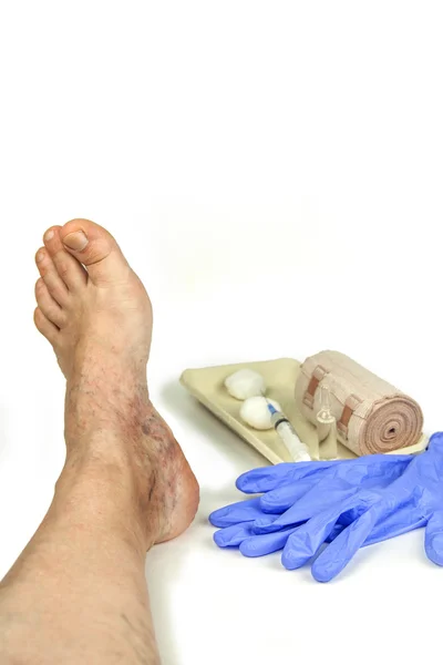 Varicose veins treatment — Stock Photo, Image