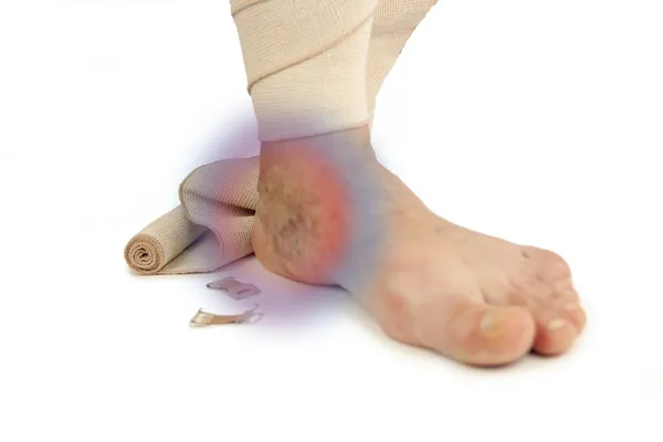 Varicose veins and bandage — Stock Photo, Image