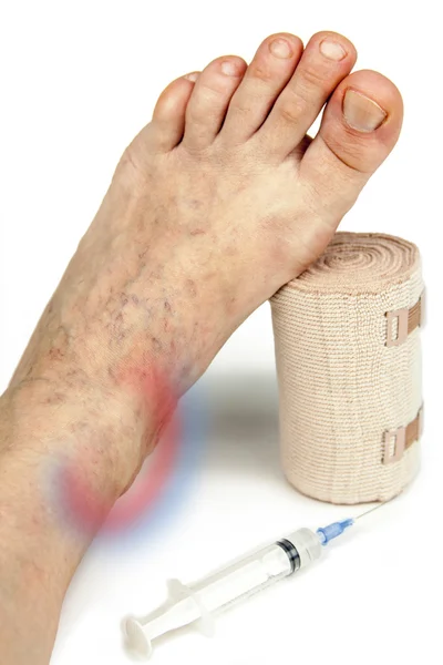 Varicose veins treatment — Stock Photo, Image