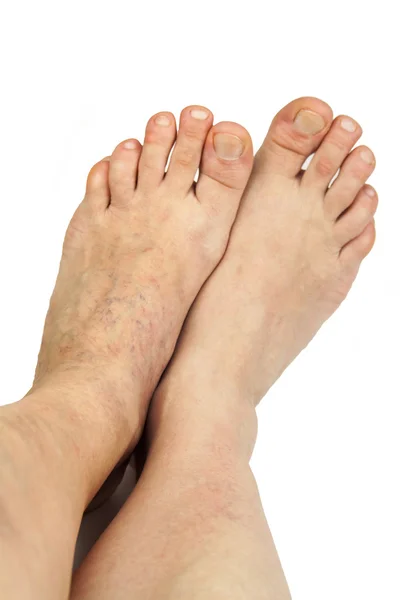 Varicose veins — Stock Photo, Image