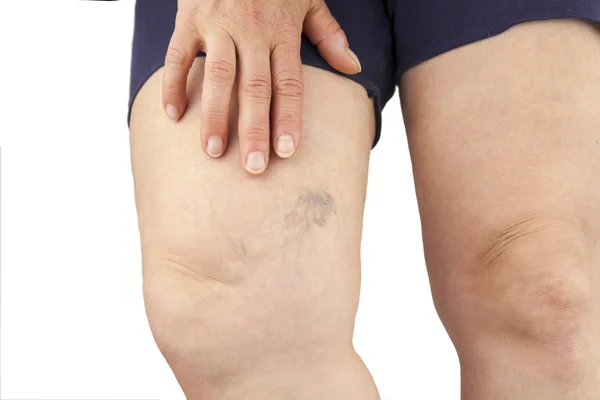 Varicose veins — Stock Photo, Image